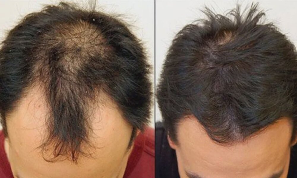 Tu pelo vuelve a crecer 100% natural